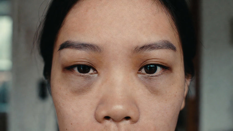 Best Med Spa Treatments for Dark Circles Under Eyes