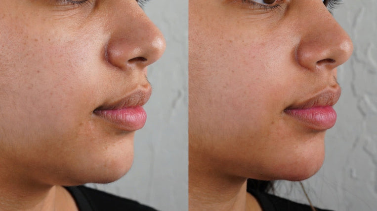 Face Slimming with Botox: Everything You Need to Know About Masseter Treatment