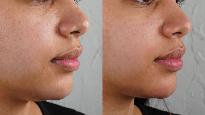 Face Slimming with Botox: Everything You Need to Know About Masseter Treatment
