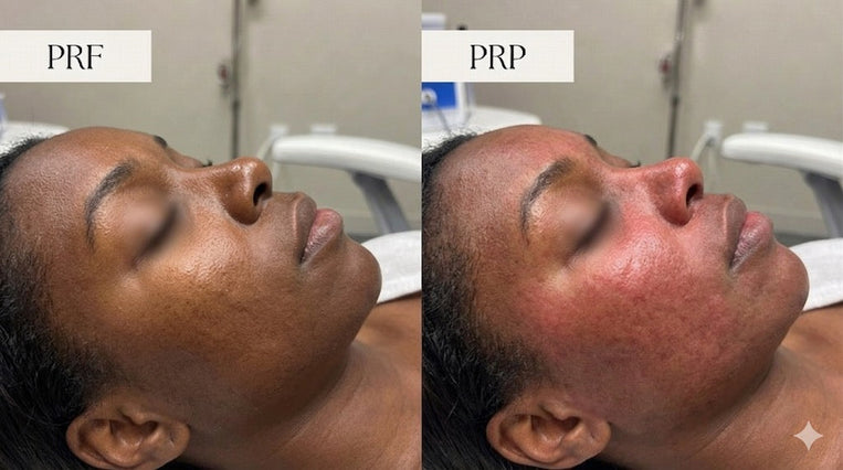 PRF vs. PRP: What's the Difference and Which Is Better?