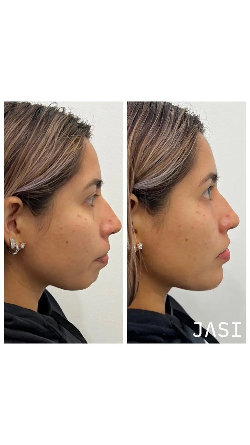 Blemish Cleanse - 10% Benzoyl Peroxide Acne Wash — Before & After 3