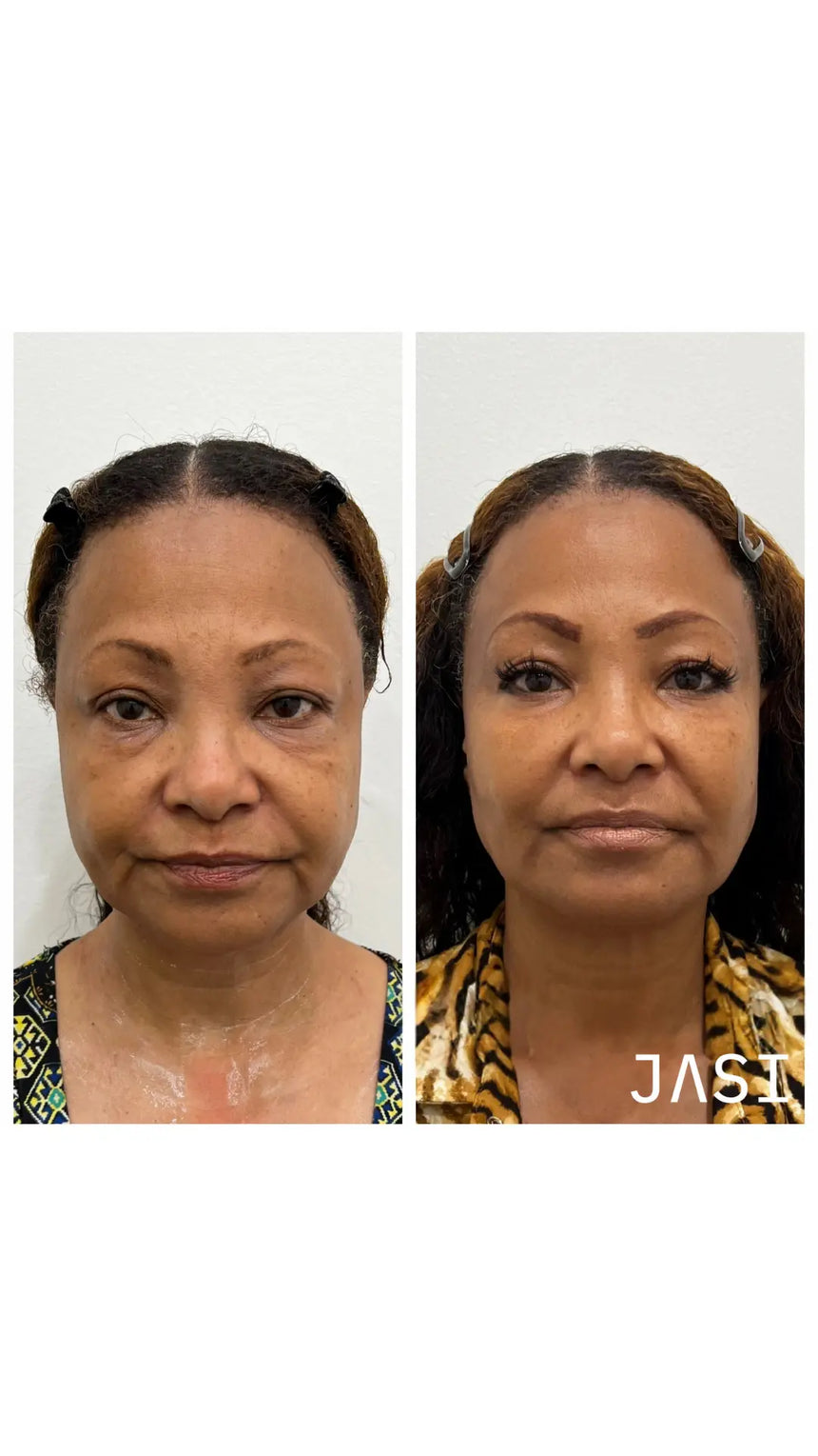 Blemish Cleanse - 10% Benzoyl Peroxide Acne Wash — Before & After 4