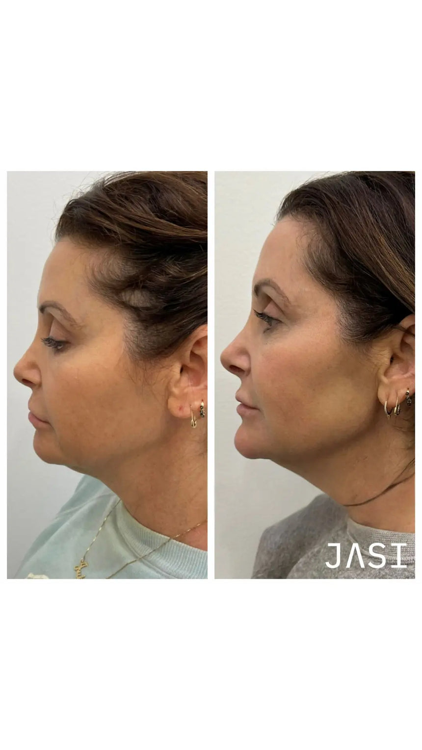 Blemish Cleanse - 10% Benzoyl Peroxide Acne Wash — Before & After 5