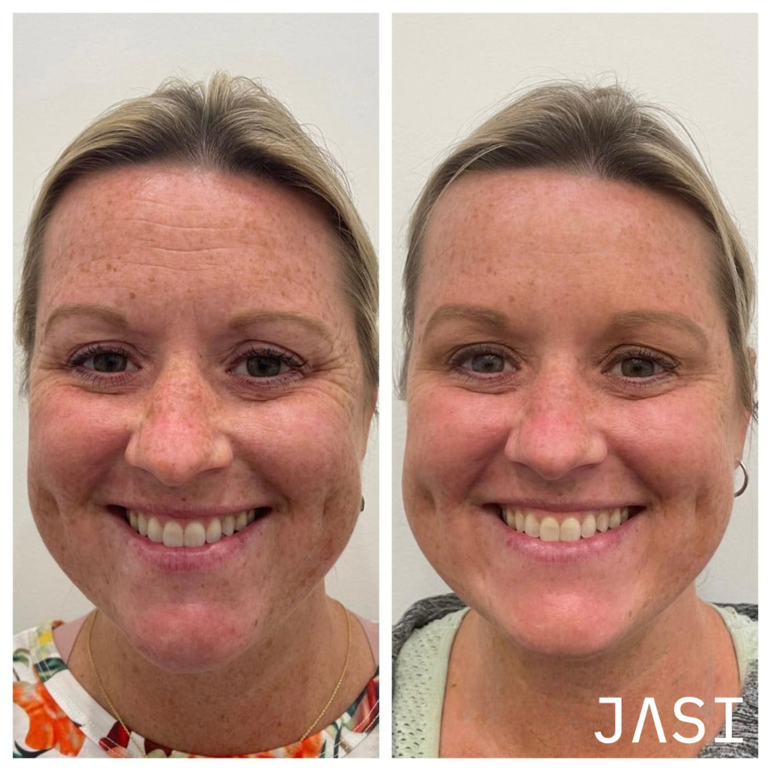 Before & After Result